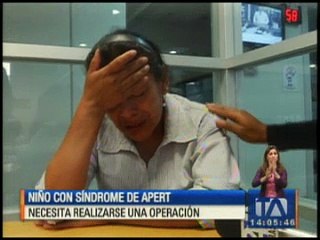 Niño con síndrome de Apert necesita realizarse una operación