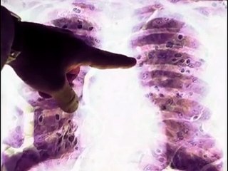 Mesothelioma survival rates