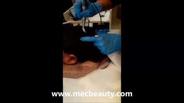 Saç Simülasyonu İzmir, Saç Simülasyonu Yaptıranlar,Saç Simülasyonu Forum