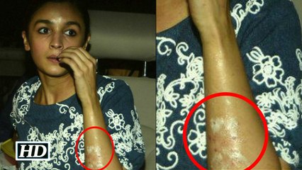 Alia Bhatt Suffers Burns On Face At An Award Show; Reacts