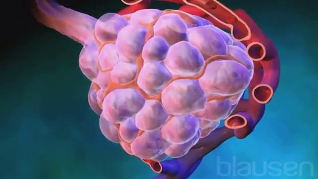 Cómo hacer el examen para detectar el cáncer de mama