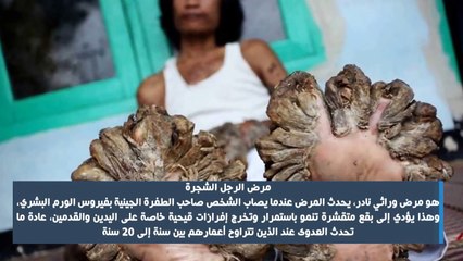 10 أمراض غريبة ونادرة