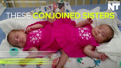 These Conjoined Sisters Could Be Separated Soon