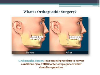 What is Orthognathic Surgery