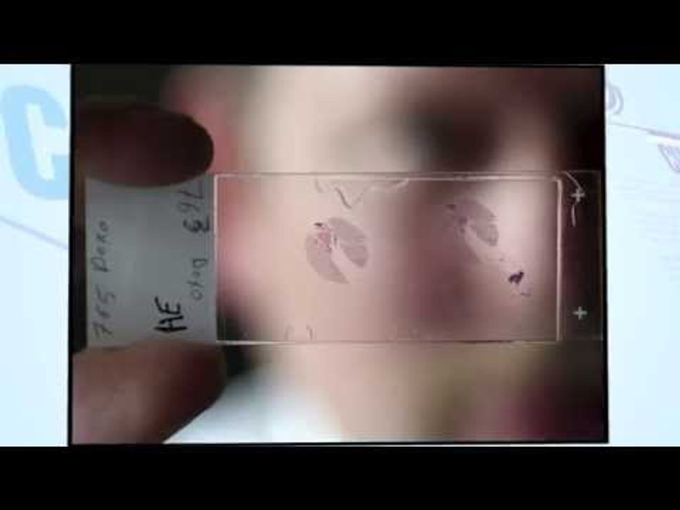 ¿Hay una cura para el cáncer? Estos avances podrían revolucionar la ciencia y combatir la enfermedad