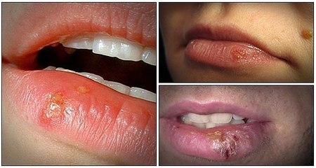 How to Get Rid of Herpes Virus Fast