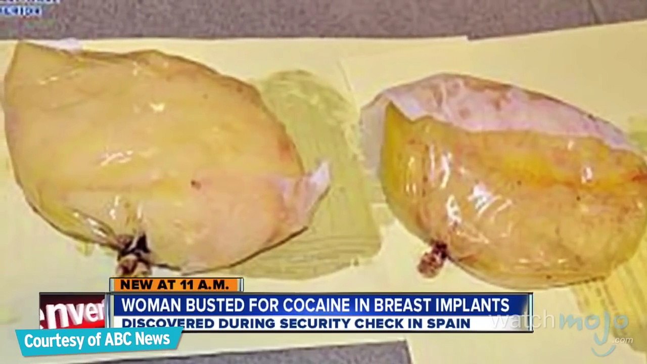 Top 5 Facts About Breast Implants