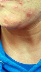 (WARNING: GROSS pt. 2) Face Worms after Hydrogen Peroxide