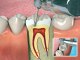 Diş Kanal Tedavisi nasıl yapılır