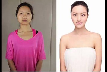 Foto-Foto Wanita China Jalani Operasi Plastik Bikin Shock