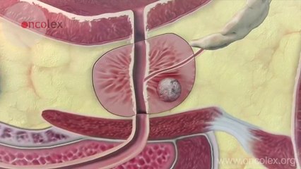 Prostate cancer- Essential facts