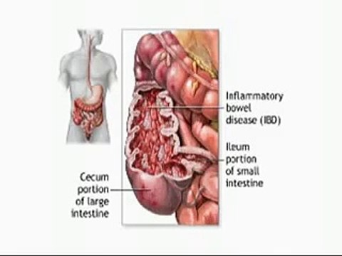 Inflammatory Bowel Disease