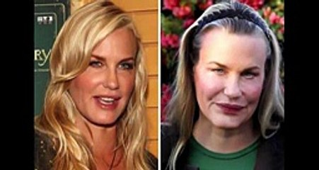 Celebrity Before-And-After Plastic Surgery Disasters