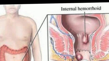 How Long Do Internal Hemorrhoids Last?