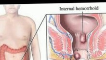 How Long Do Internal Hemorrhoids Last?