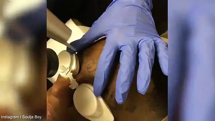 Soulja Boy gets laser treatment on his face to remove Gucci tattoo from his forehead