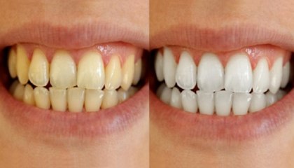 How to Whiten Your Teeth Naturally at Home with Turmeric