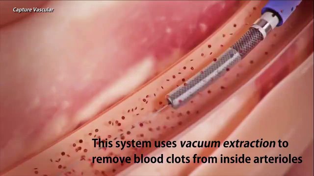 Removing cholesterol plagues from blood arteries (concept Only)