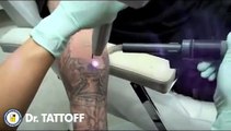Tattoo removal on Arm by Laser is mesmerizing!