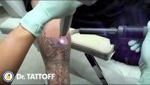 Séance de laser pour retirer une tatouage : hypnotisant