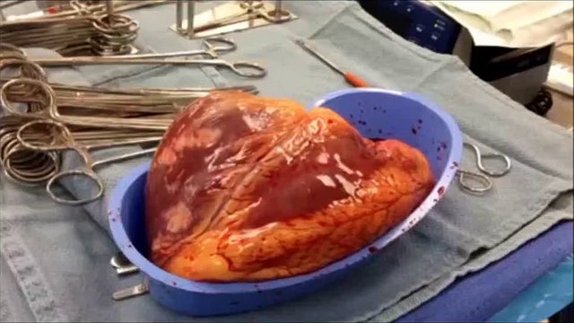 Cocaïne addict cœur continue à battre 25 minutes après avoir été enlevé