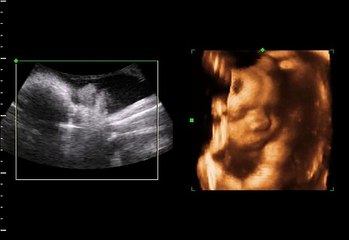 Ultrasound 3D 015