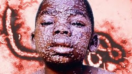 Top 10 Deadliest Diseases Of All Time