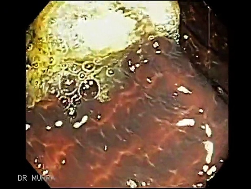 Colonoscopia de Melanosis Coli Severa