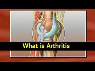 Video herunterladen: What is Arthritis - Causes, Symptoms, Treatments and Diet Tips in English