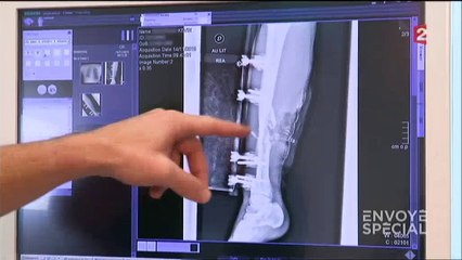 Le très touchant témoignage de Kévin, rescapé du Bataclan qui a été touché par deux balles dans la jambe et qui a été am