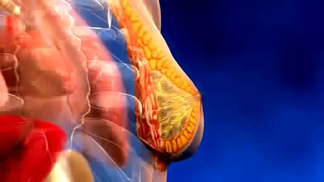 Augmentation des seins  par implant mammaire