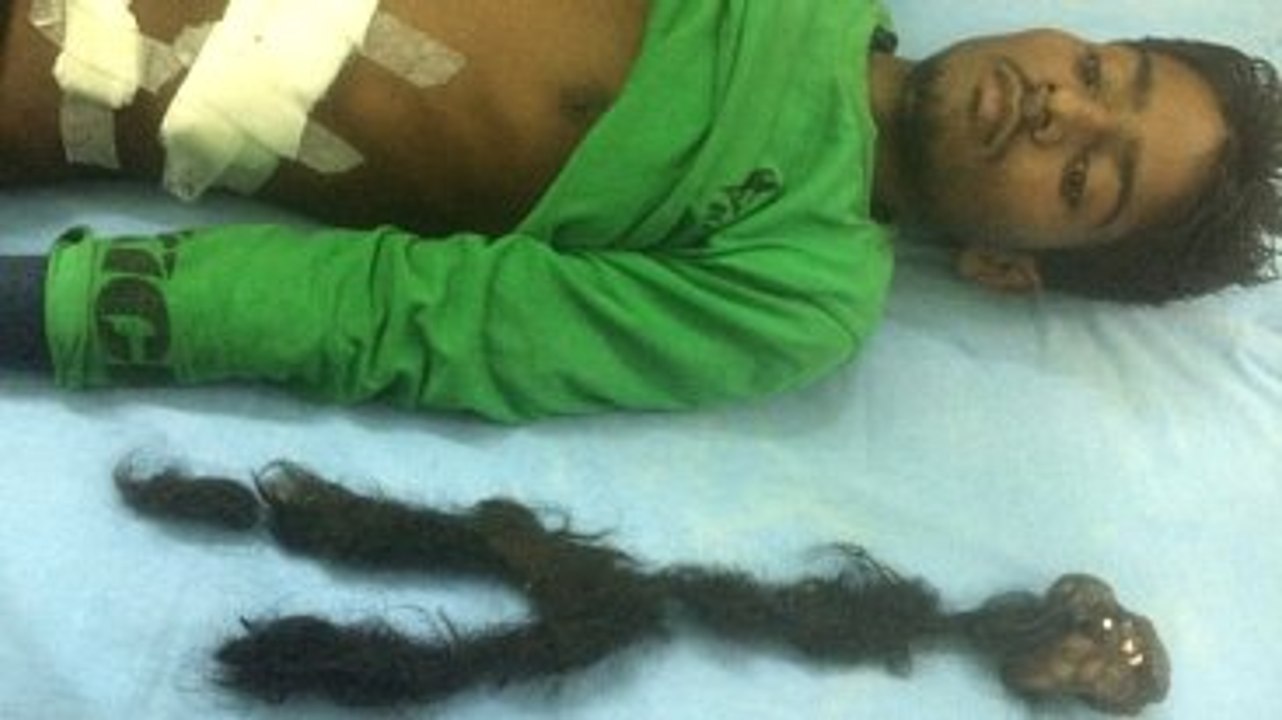 Doktorlar Hayretler İçinde! Hintli Gencin Karnından İkizi Çıktı