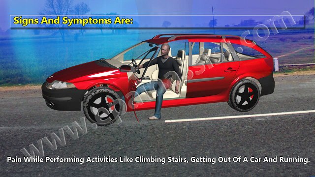 Hip Bursitis or Trochanteric Bursitis 3D Video: Watch How it is Caused, Know Its Treatment, PT, Symptoms
