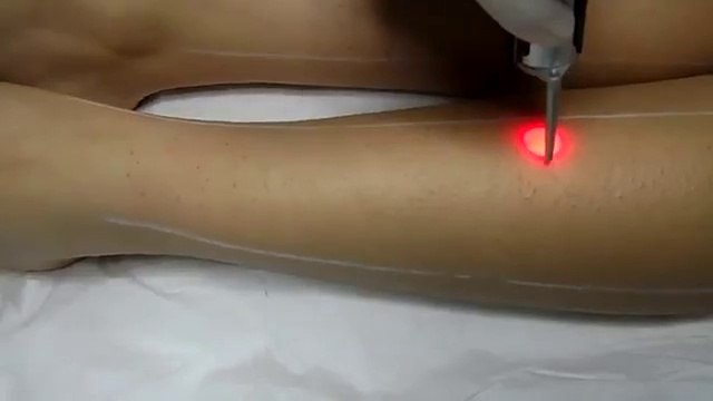 Ankara lazer epilasyon