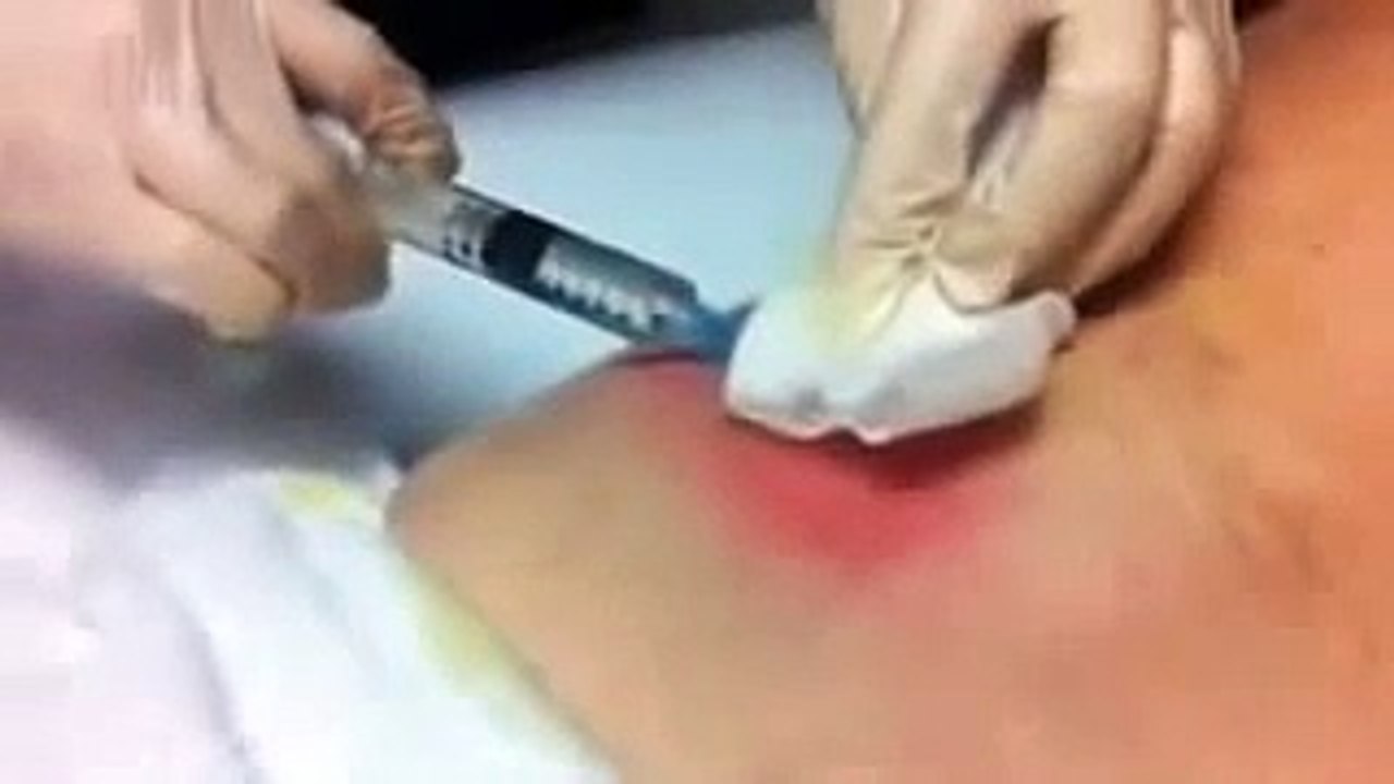 how to squeeze a big spot