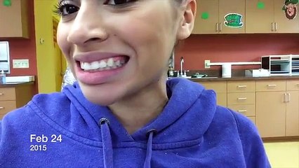 MY 3 YEAR BRACES EXPERIENCE!! (Before/After + Q & A)