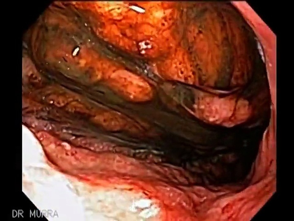 Cáncer Estómago Linitis Plástica