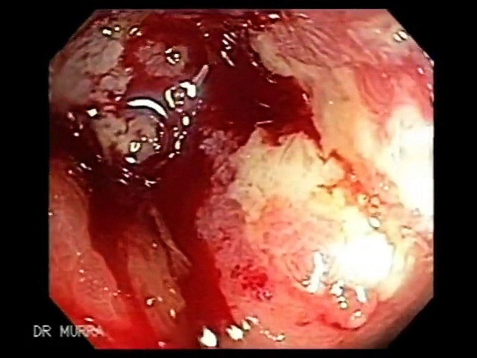 Cancer of the Colon and large Polyps