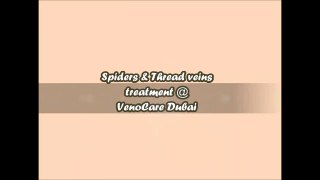 Laser Vein Treatment with VenoCare Varicose Vein Specialist +971 52 993 6643