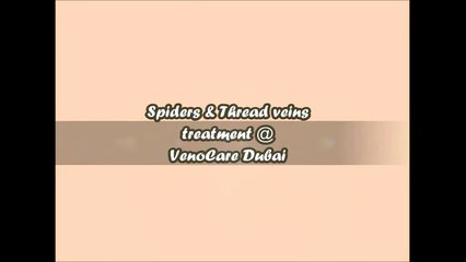 Varicose Vein Ablation at the best vein clinic in Dubai +971 52 993 6643