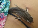 Genç Kızın Karnına Saplanan Balığı Ameliyatla Çıkardılar