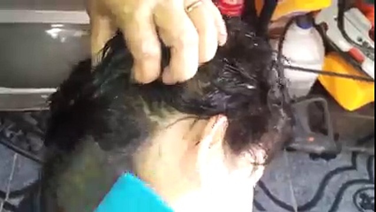 Child Infested With Lice ! INCREDIBLE !