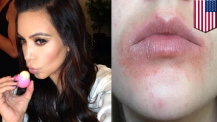 EOS lip balm users claim celebrity-endorsed beauty product messed up their mouths