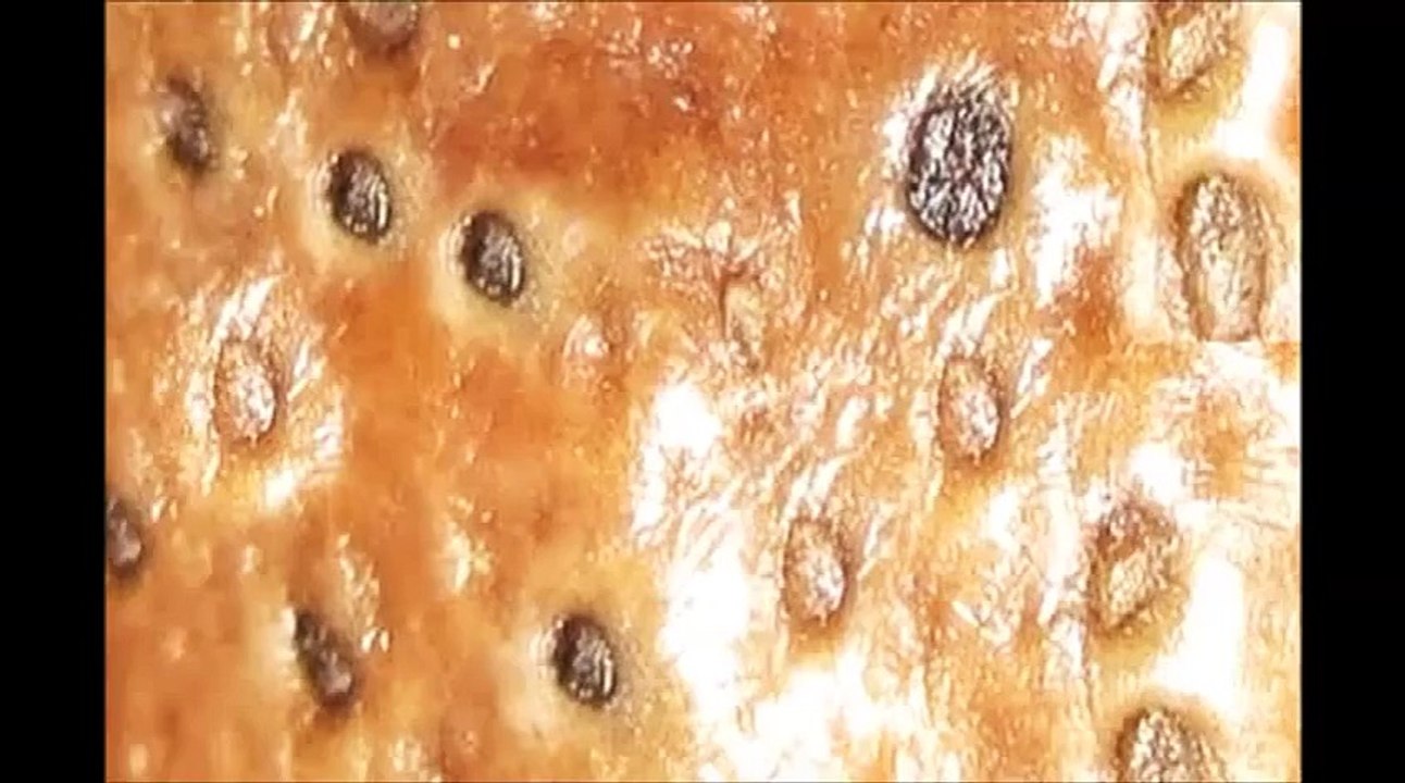 Blackheads (Blackheads) in Ear - Part One