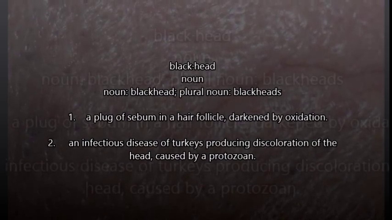 Blackhead Removed;  Blackheads Defined