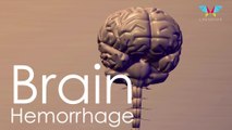 Important Information about Brain Hemorrhage