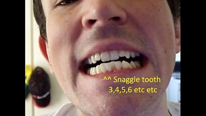 Braces Photo taken every day Before and After Transformation Orthodontics Timelapse