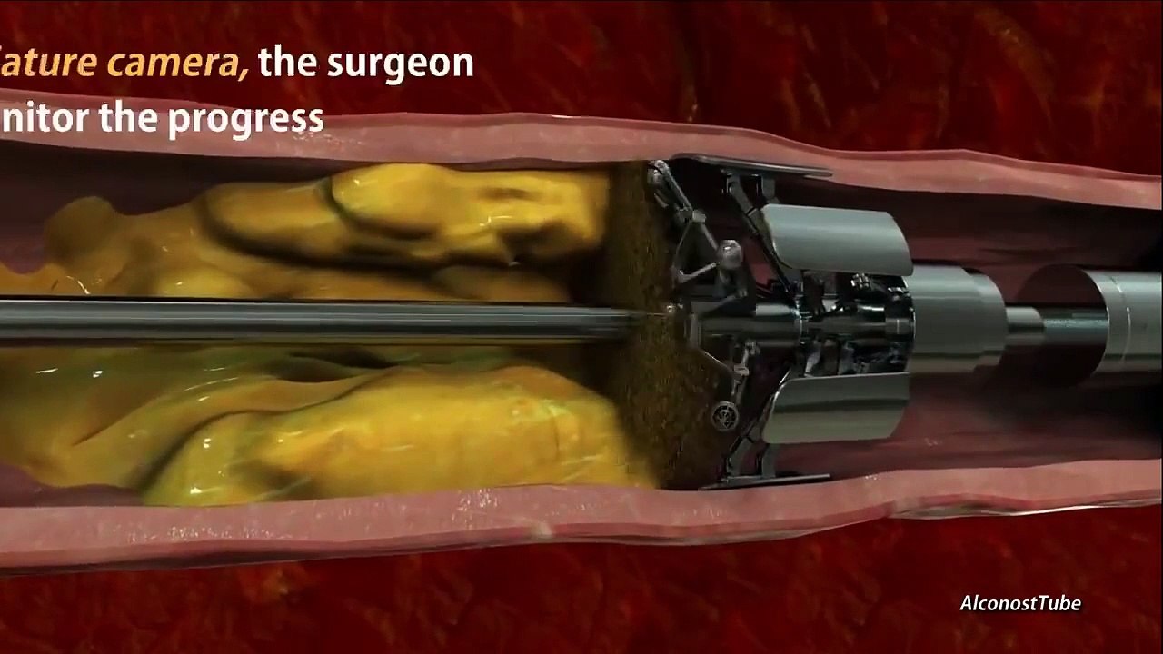 A Machine That Can Remove Cholesterol Plaques