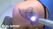 Los Angeles Laser Tattoo Removal Before and after tattoo removal on shoulder