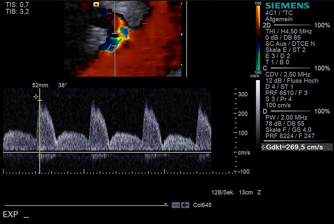 Truncus coeliacus-kompressionssyndrom